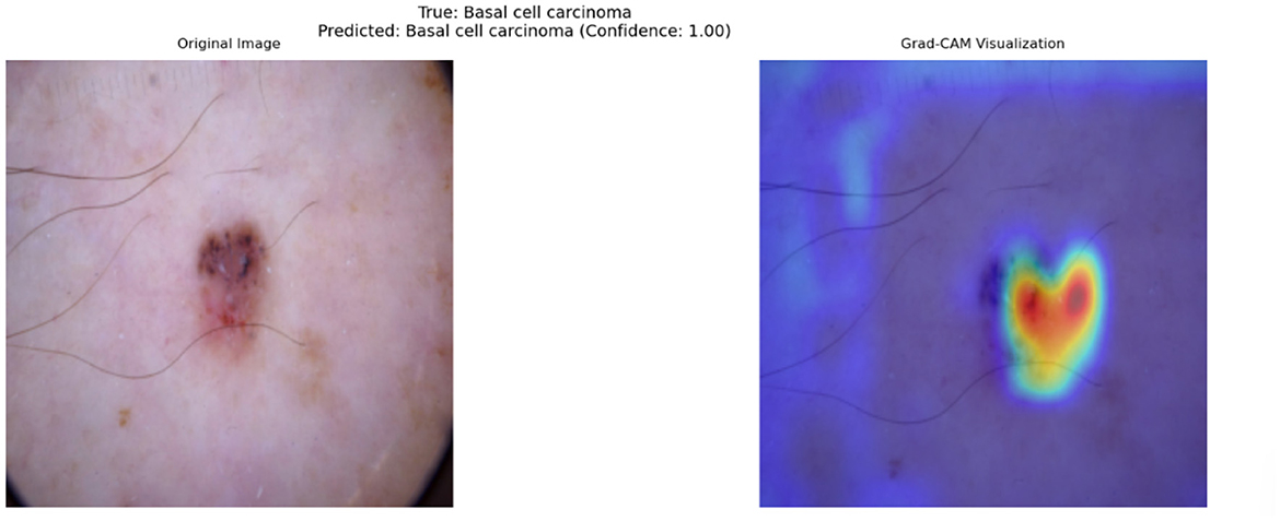 Original image of a skin lesion identified as basal cell carcinoma next to a Grad-CAM visualization. The Grad-CAM highlights the lesion area with vibrant colors, indicating the model's focus, predicting basal cell carcinoma with full confidence.