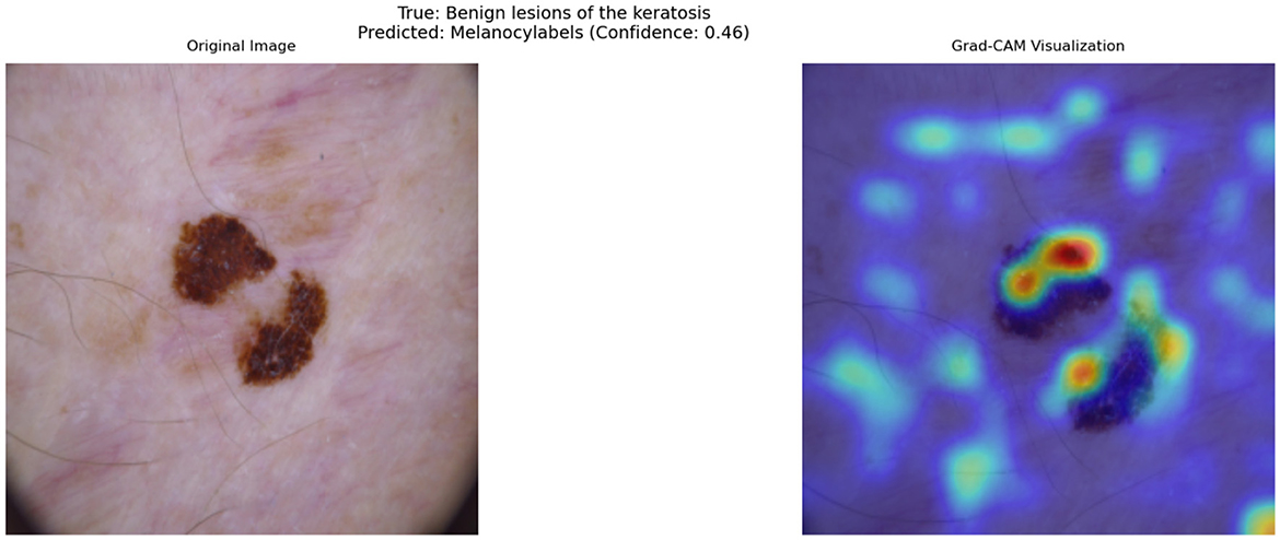 Skin shows two dark brown lesions on the left, labeled “Original Image.” On the right, a Grad-CAM visualization highlights regions of interest with warm colors, indicating a confidence prediction of 0.46 for melanocytic labels. The true diagnosis is benign keratosis lesions.