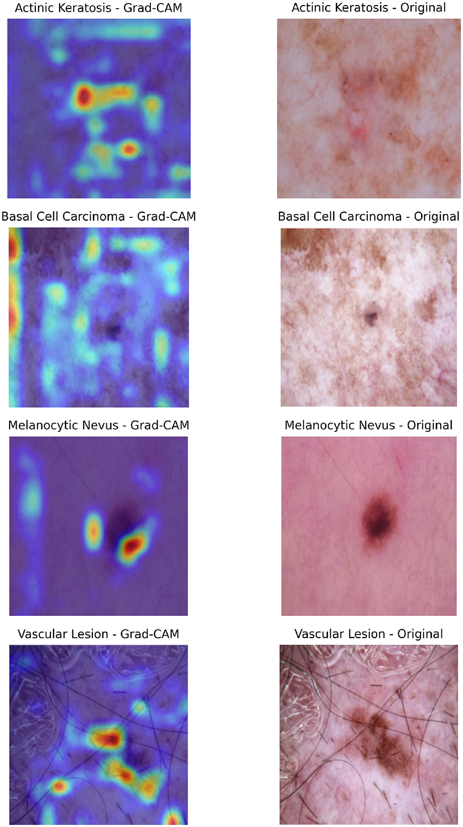 Composite visualization of Grad-CAM outputs for selected classification cases. For each sample, the left panel shows the Grad-CAM heatmap overlaid on the dermatoscopic image, highlighting regions the model attended to during prediction. The right panel displays the original dermatoscopic image with the ground truth label indicated. This layout enables intuitive interpretation of model focus and correctness of attention alignment.