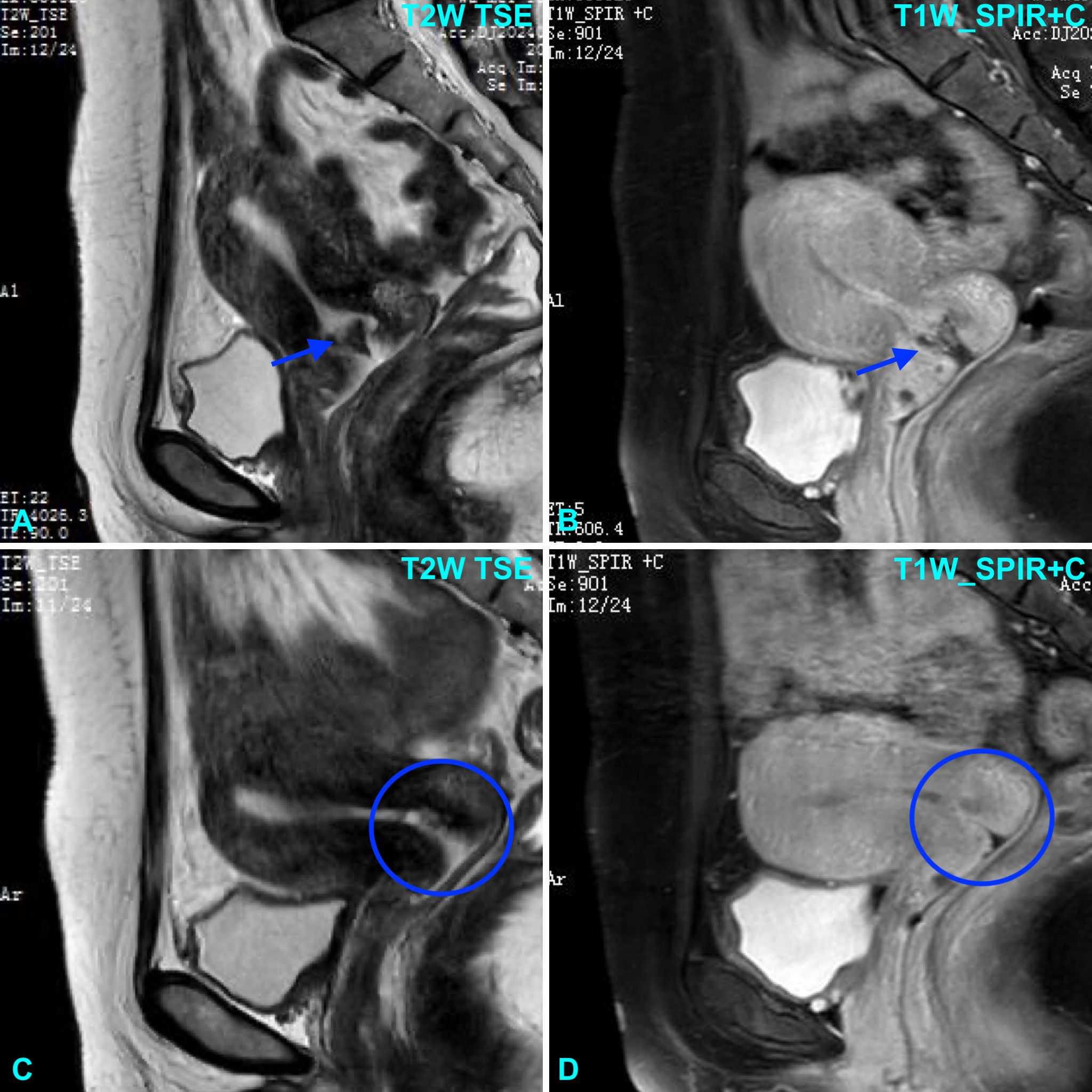 Four-panel MRI scans, labeled 'T2W TSE' and 'T1W SPIR+C', display sagittal views of a pelvis. Top images show an arrow pointing to an area of interest. Bottom images highlight another area with a circle. Each scan reveals different tissue contrasts.