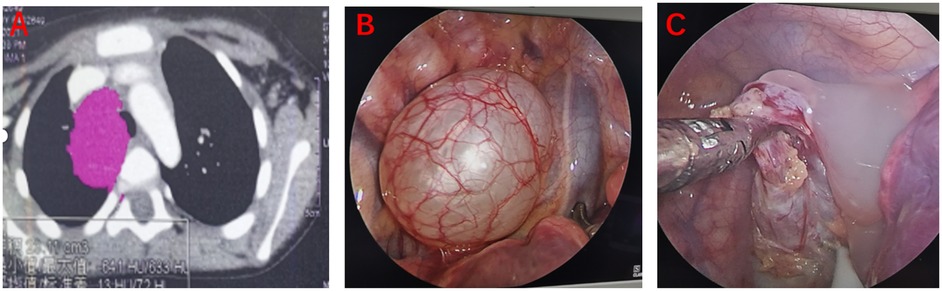A. CT scan showing a highlighted mass in the chest area, marked in purple. B. Endoscopic view of a round mass with visible blood vessels on the surface. C. Instrument probing a mass within the body cavity, showing texture and surrounding tissue.