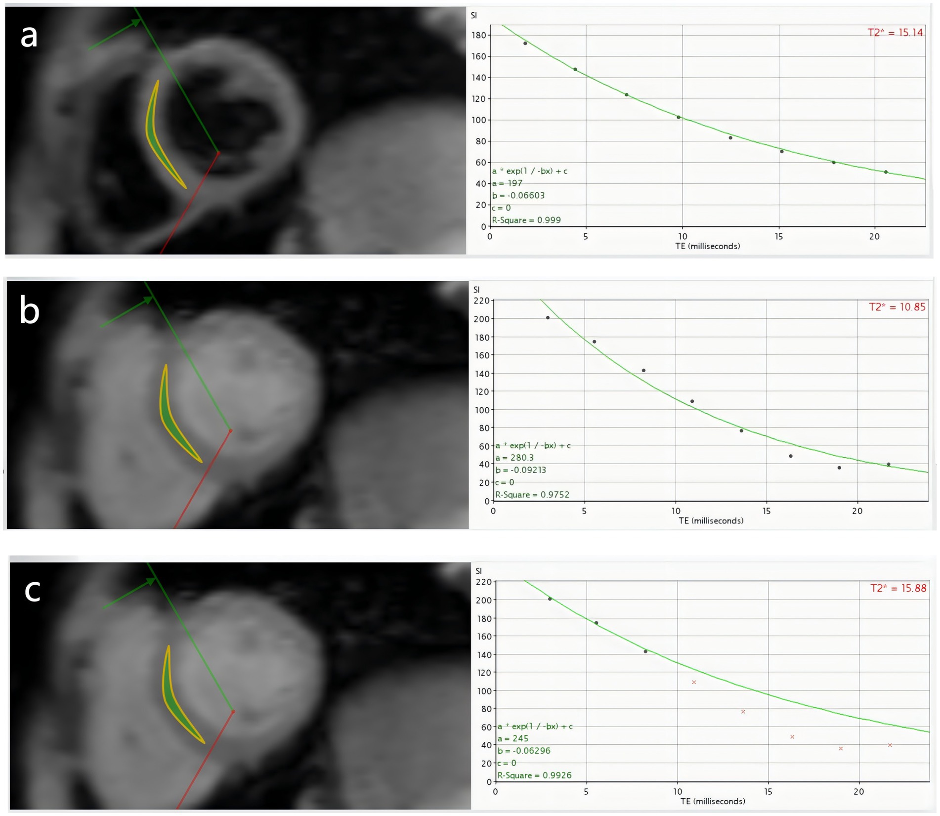 Three MRI images with corresponding graphs showing T2 relaxation times. Image (a) has a T2* of 15.14 milliseconds with an R-square of 0.999. Image (b) shows a T2* of 10.85 milliseconds with an R-square of 0.9752. Image (c) has a T2* of 15.88 milliseconds with an R-square of 0.9926. Each graph plots signal intensity (SI) against echo time (TE) with exponentials fitting the data points.