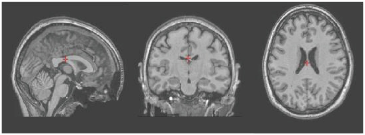 Three MRI scans of a human brain are shown: a sagittal view on the left, a coronal view in the center, and an axial view on the right. Red crosshairs indicate focus points in each scan.
