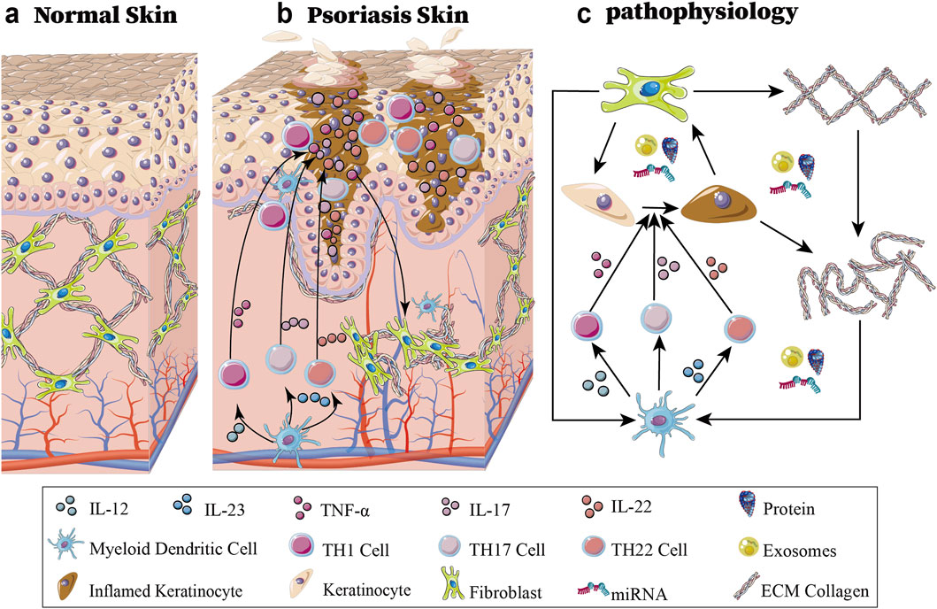 Illustration comparing normal skin and psoriasis skin, with pathophysiological processes. Panel a shows normal skin structure with layers and cells like fibroblasts and myeloid dendritic cells. Panel b depicts psoriasis skin with inflamed keratinocytes, increased cell proliferation, and immune infiltrates. Panel c outlines the pathophysiology, illustrating interactions between proteins, cells like TH1 and TH17, and inflammatory cytokines such as IL-12 and TNF-α, with microRNA involvement. A legend identifies symbols for various molecules and cells.