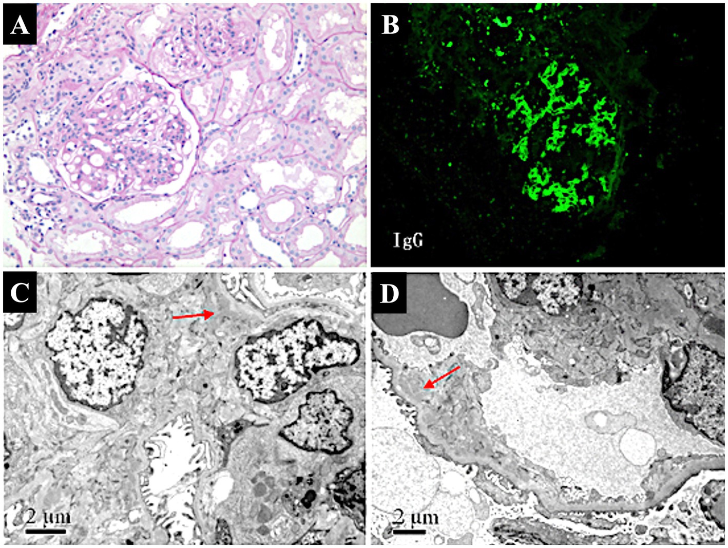 Panel A shows a light microscopy image of a kidney glomerulus stained with hematoxylin and eosin, revealing cellular structures. Panel B displays an immunofluorescence image highlighting IgG deposits in green. Panel C and D are electron microscopy images showing ultrastructural details of the glomerular basement membrane with red arrows indicating specific areas of interest, captured at a scale of two micrometers.