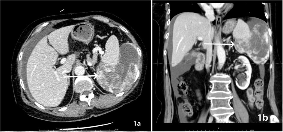 CT scans of the abdomen showing two different views. Image 1a is a transverse view, while image 1b is a sagittal view. Both images feature an arrow pointing to a noticeable mass, suggesting an abnormality in the abdominal region.