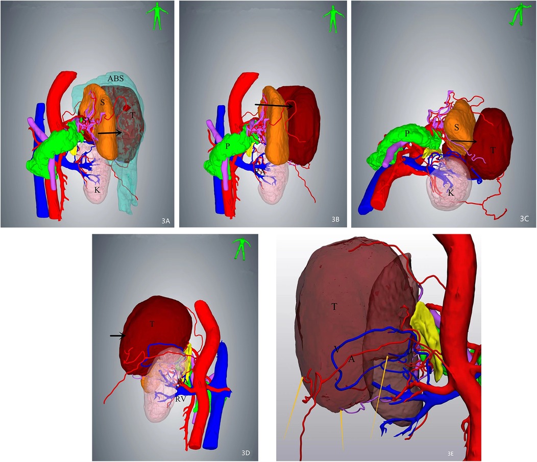 Five-panel medical illustration showing detailed anatomical structures. Panels 3A to 3E display colored representations of organs, labeled as ABS, S, P, T, K, RV, and A, with prominent red, blue, and green vascular systems. The top row highlights connections between different organs and vessels, while the bottom row focuses on a larger organ labeled T, showcasing its vascular complexity. The use of vibrant colors helps differentiate each anatomical feature. A stylized human figure is present in the top right corner of each panel to indicate orientation.
