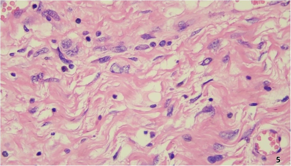 Microscopic view of a tissue section stained for histological examination. Pink-stained fibrous matrix with scattered dark purple nuclei indicates cells, likely in connective tissue.