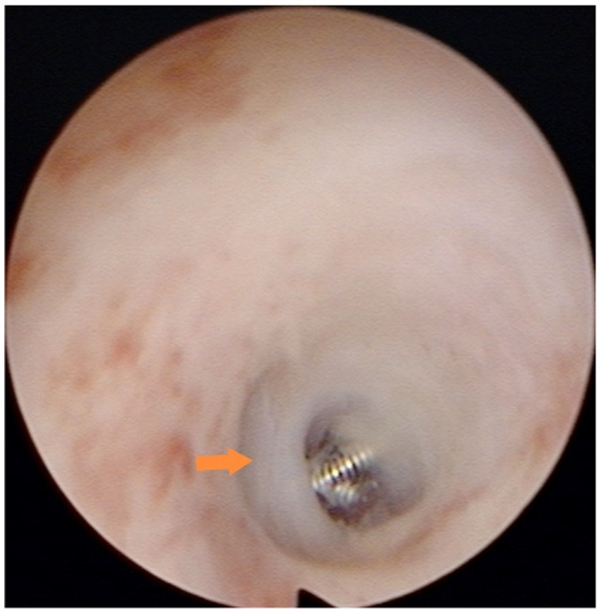Hysteroscopic view showing the microcoil placed in the isthmic portion of the fallopian tube. Only the distal end of the microcoil can be seen protruding slightly from the tubal ostium.