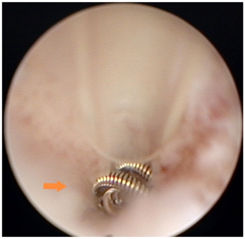 Hysteroscopic view showing the microcoil deployed within the interstitial portion of the fallopian tube. Approximately three concentrically stacked loops of the microcoil are visible at the tubal ostium.