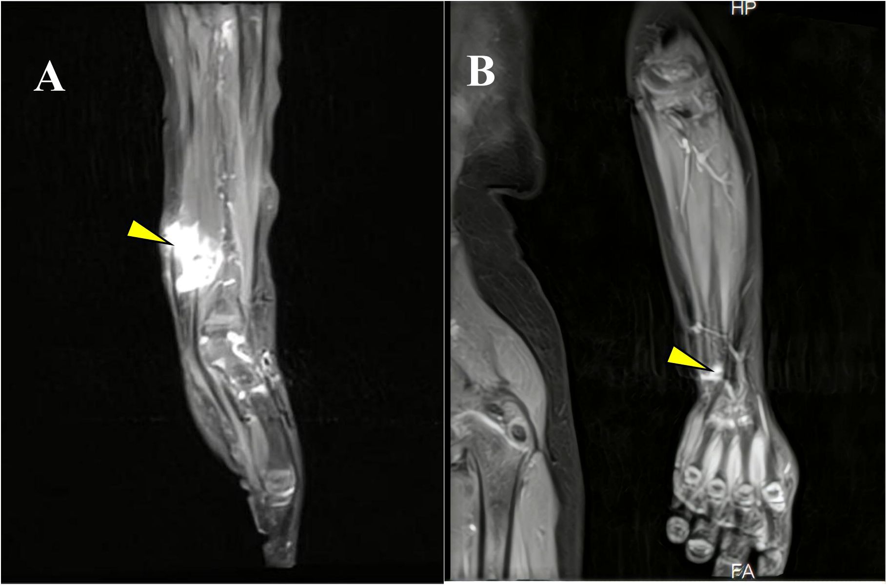 MRI scans of a forearm with two images labeled A and B. Image A shows a longitudinal view with a yellow arrow indicating an area of interest in the tissue. Image B shows a cross-sectional view of the same forearm, also highlighting the area of interest with a yellow arrow.