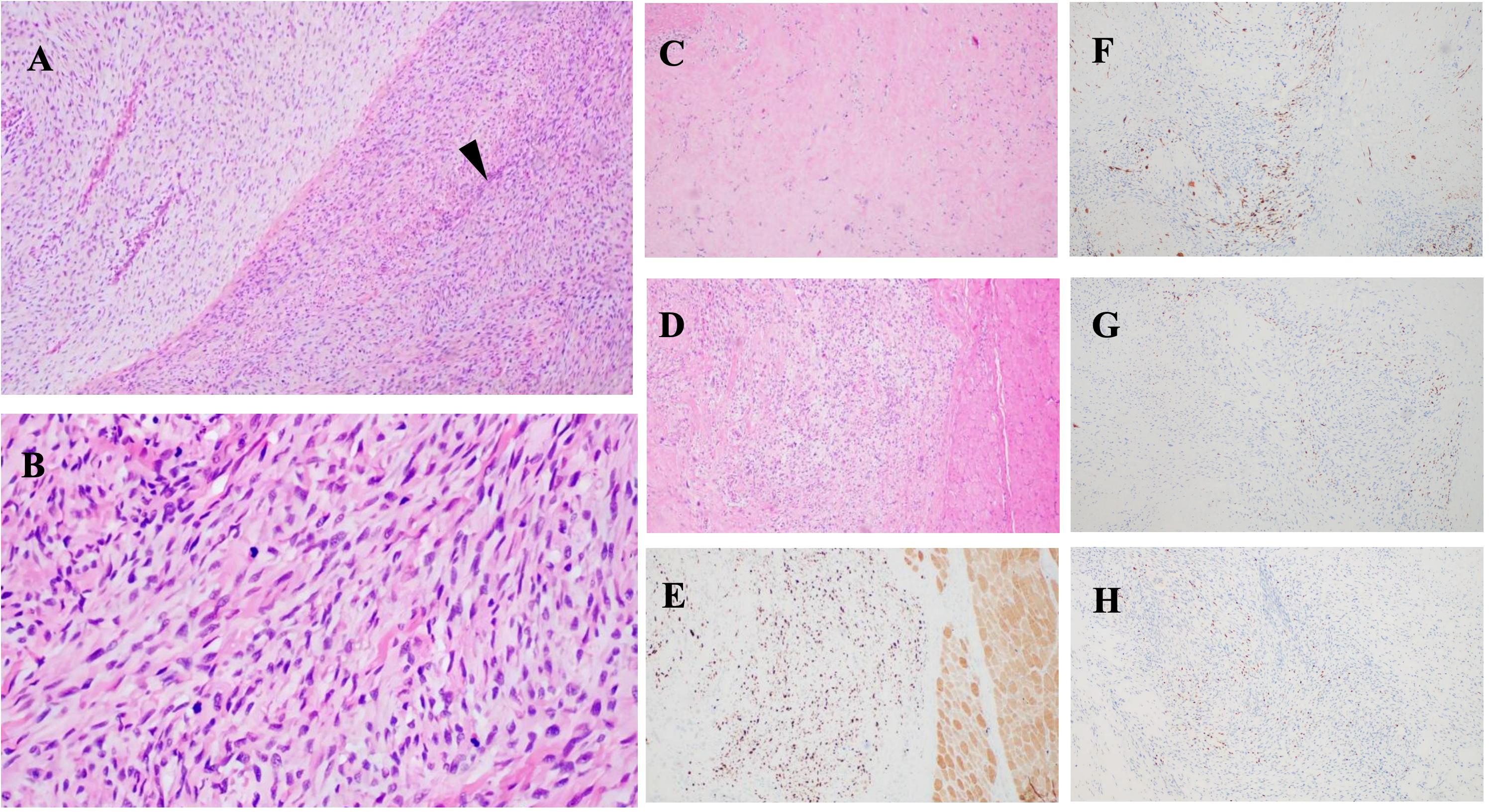 Histological images showing various sections labeled A to H. Panel A displays tissue at low magnification with a transition zone marked by an arrowhead. Panel B shows a high magnification of spindle-like cells. Panels C and D exhibit low magnification of different tissue patterns. Panel E presents a stained section with denser cell groups. Panels F, G, and H display tissue sections with dispersed cell distributions and light staining.