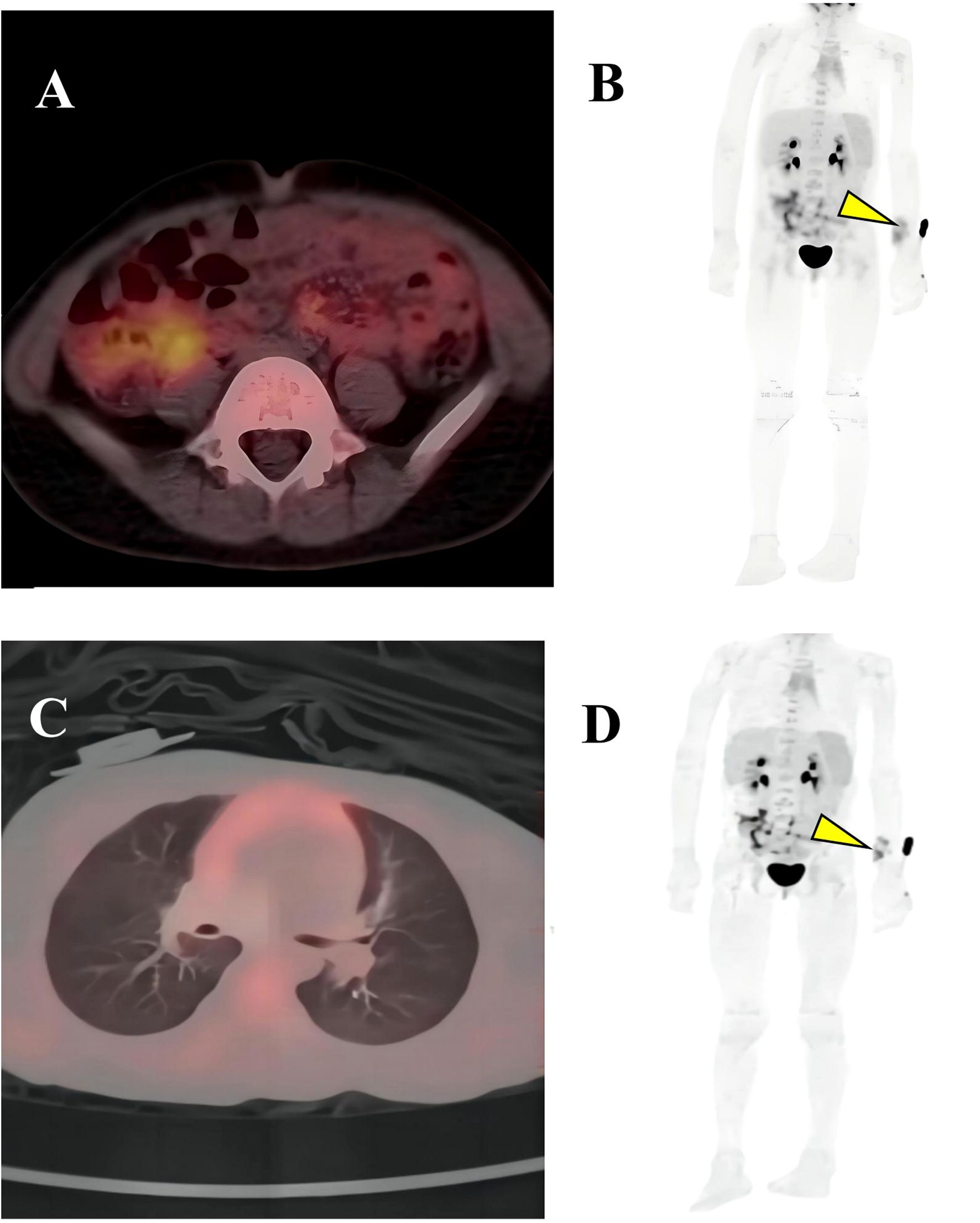 Four-panel medical imaging figure. Panel A shows an axial PET/CT scan of the abdomen with highlighted areas. Panel B is a full-body PET scan indicating a high-intensity region with a yellow arrow on the right arm. Panel C displays a cross-section of the chest with lung details in a PET/CT scan. Panel D is similar to panel B, with a yellow arrow highlighting the right arm.