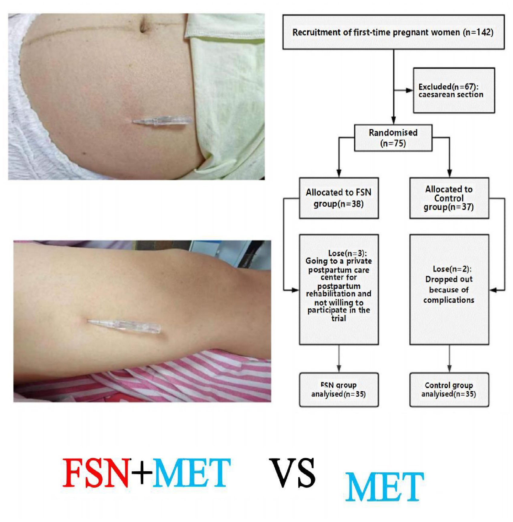 Two images of acupuncture needles in a woman’s abdomen and leg, alongside a flowchart of a clinical trial. The trial involved 142 women, with 67 excluded due to caesarean sections. The remaining 75 were randomized into two groups: FSN group (38 participants) and a control group (37 participants). Three from the FSN group and two from the control group dropped out, each leaving 35 participants analyzed. The text “FSN+MET vs MET” is displayed at the bottom.