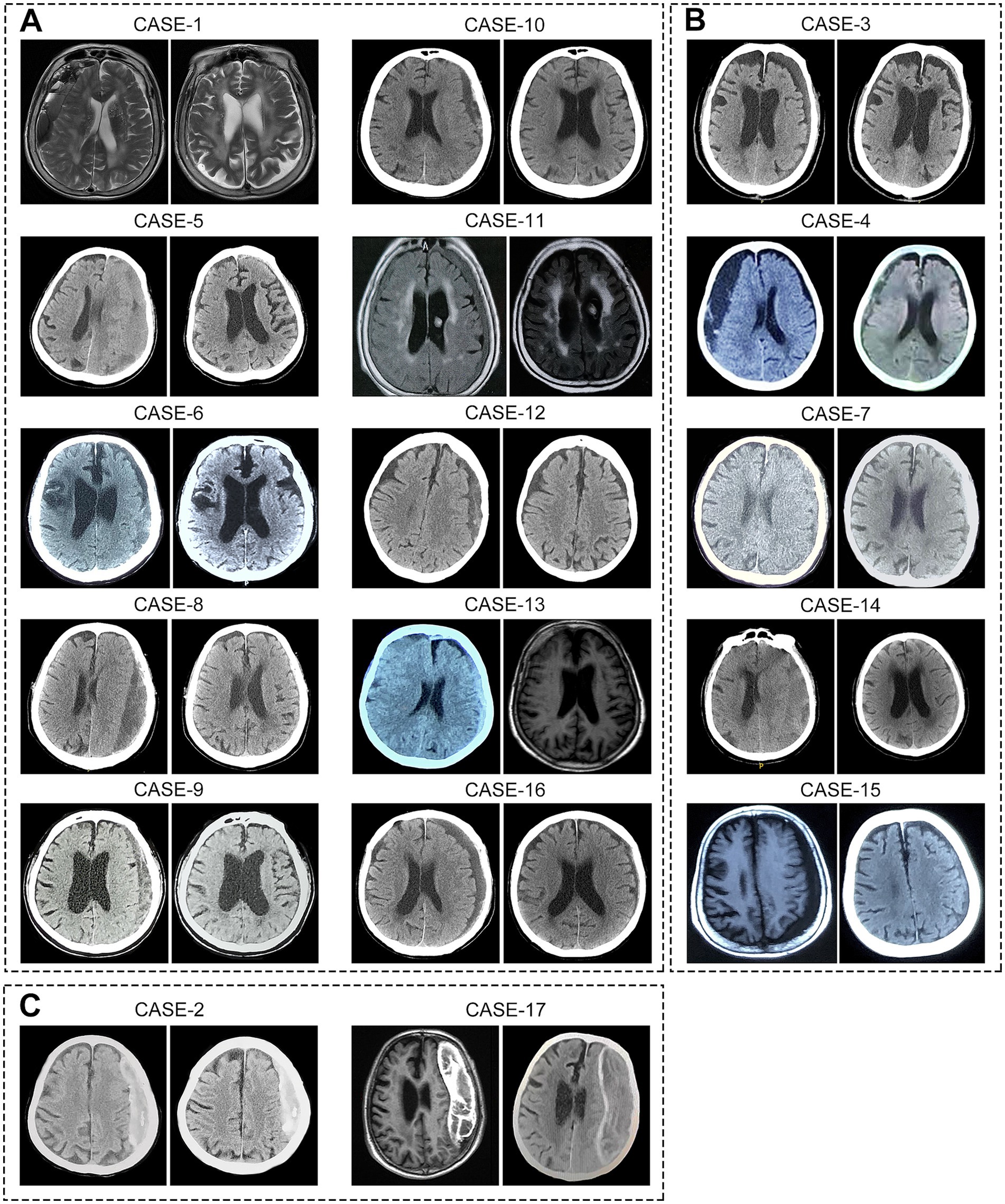 Multiple sets of brain MRI scans are displayed in a grid layout divided into sections A, B, and C. Each section contains pairs of images from different cases numbered 1 to 17. The scans show variations in brain structures, likely for comparative analysis. Sections are distinct with noticeable differences in brain scans, indicating different cases or conditions.