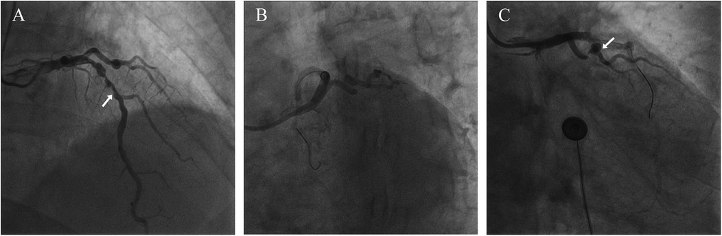 Three-panel coronary angiogram images. Panel A shows a blocked artery indicated by an arrow. Panel B displays a different artery without blockages. Panel C shows another artery with a blockage, marked by an arrow.