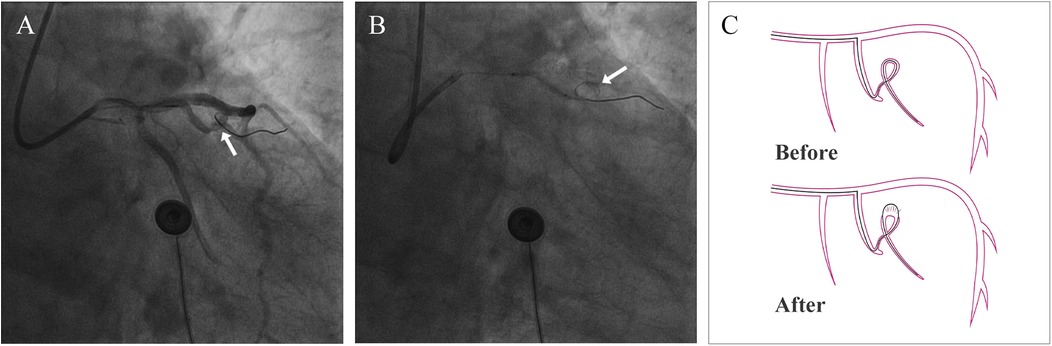Angiograms labeled A and B show coronary arteries with arrows pointing to regions of interest. Diagram C illustrates a \