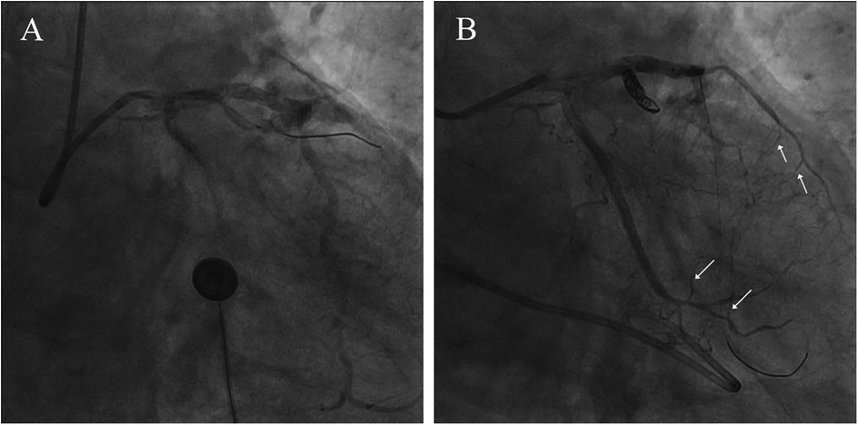 Two x-ray images of coronary angiograms labeled A and B. Image A shows a narrowed coronary artery. Image B shows multiple white arrows indicating areas of improved blood flow post-intervention.