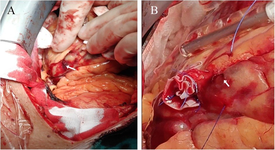 Surgical images showing two views labeled A and B. Image A displays a close-up of internal organs with a gloved hand, highlighting a specific area with an arrow. Image B shows another internal view, focusing on a stitched section of tissue, also marked with an arrow for emphasis. Both images involve surgical instruments and are detailed with blood and tissues.
