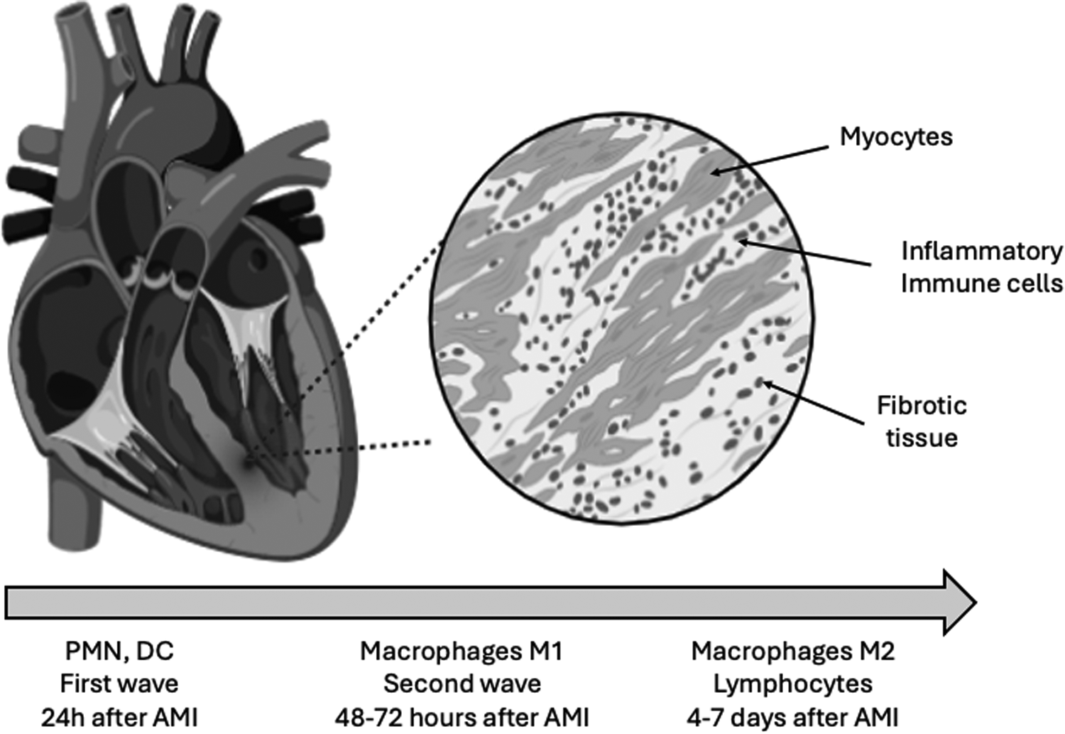 Diagram of a heart with a zoom-in on tissue showing myocytes, inflammatory immune cells, and fibrotic tissue. Below, a timeline details immune response waves post-acute myocardial infarction (AMI): PMN, DC first wave at twenty-four hours, macrophages M1 second wave at forty-eight to seventy-two hours, and macrophages M2, lymphocytes four to seven days after AMI.