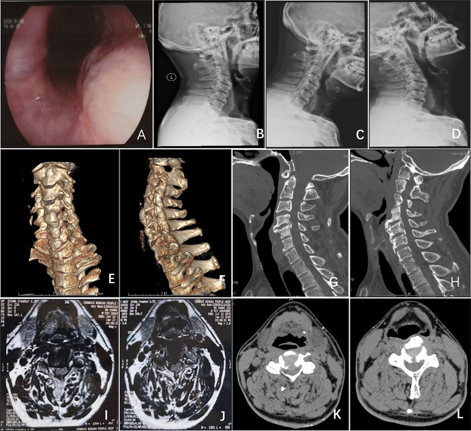 A medical collage featuring various images related to the cervical spine. Image A shows an endoscopic view of the trachea. Images B to D present lateral cervical spine x-rays in different positions. Images E and F are 3D reconstructions of the cervical spine. Images G and H are sagittal CT scans. Images I to L display axial MRI and CT scans of the cervical region, highlighting different tissue contrasts and structures.