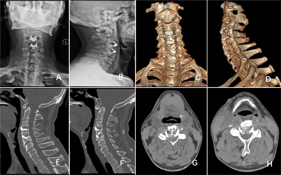 X-ray and CT images of the cervical spine in multiple views. Panels A and B show lateral x-ray images with spinal hardware. Panels C and D present 3D CT reconstructions of the vertebrae from different angles. Panels E and F depict sagittal CT views highlighting the vertebrae and spinal alignment. Panels G and H are axial CT scans of the upper cervical spine, showing cross-sections with visible bone and soft tissue structures.