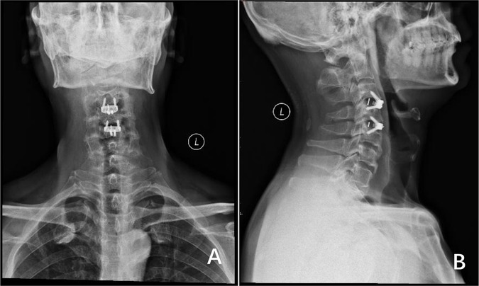 X-ray images of the neck in two orientations. Panel A shows a front view with two metal implants visible along the cervical spine. Panel B presents a side view of the same area, highlighting the position of the implants in relation to the vertebrae. Both images are marked with the letter \