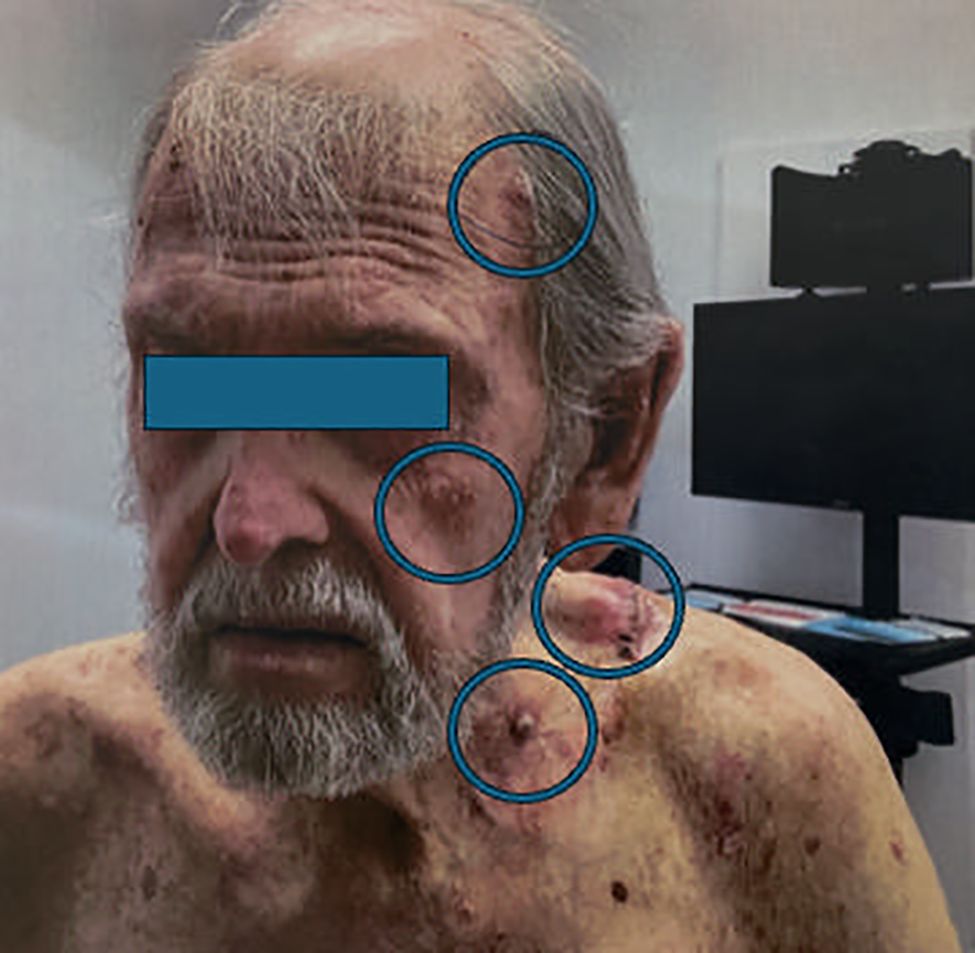 Elderly man with facial features obscured by a blue bar. Several areas on his head, face, and shoulder are circled, highlighting skin lesions and blemishes. A computer monitor is visible in the background.