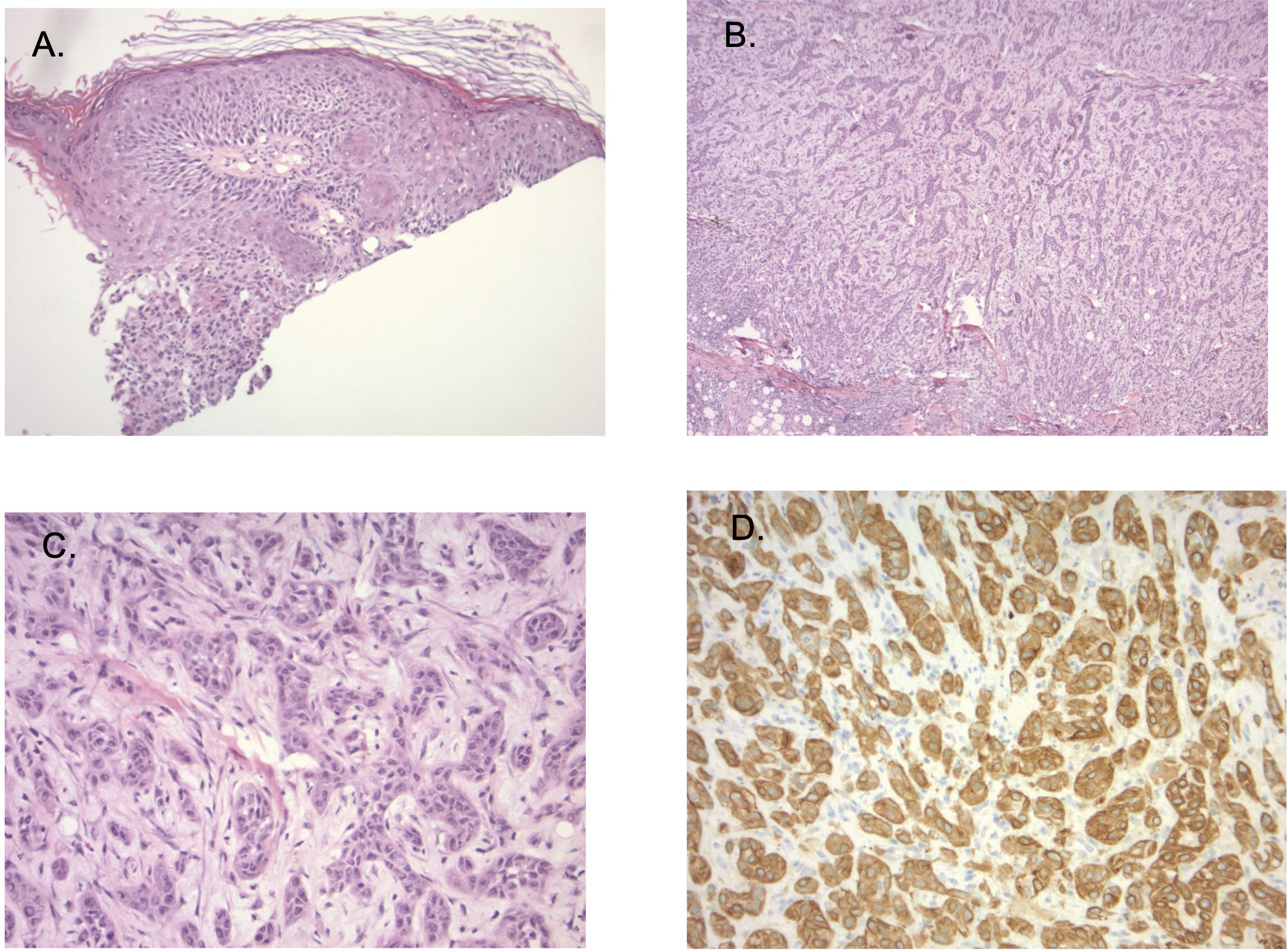 Histological slides labeled A to D. A shows a thickened stratified epithelium with dense underlying tissue. B displays a dense fibrous tissue pattern. C reveals tightly packed cells with irregular shapes. D shows a brown-stained cell pattern indicating a specific marker expression.