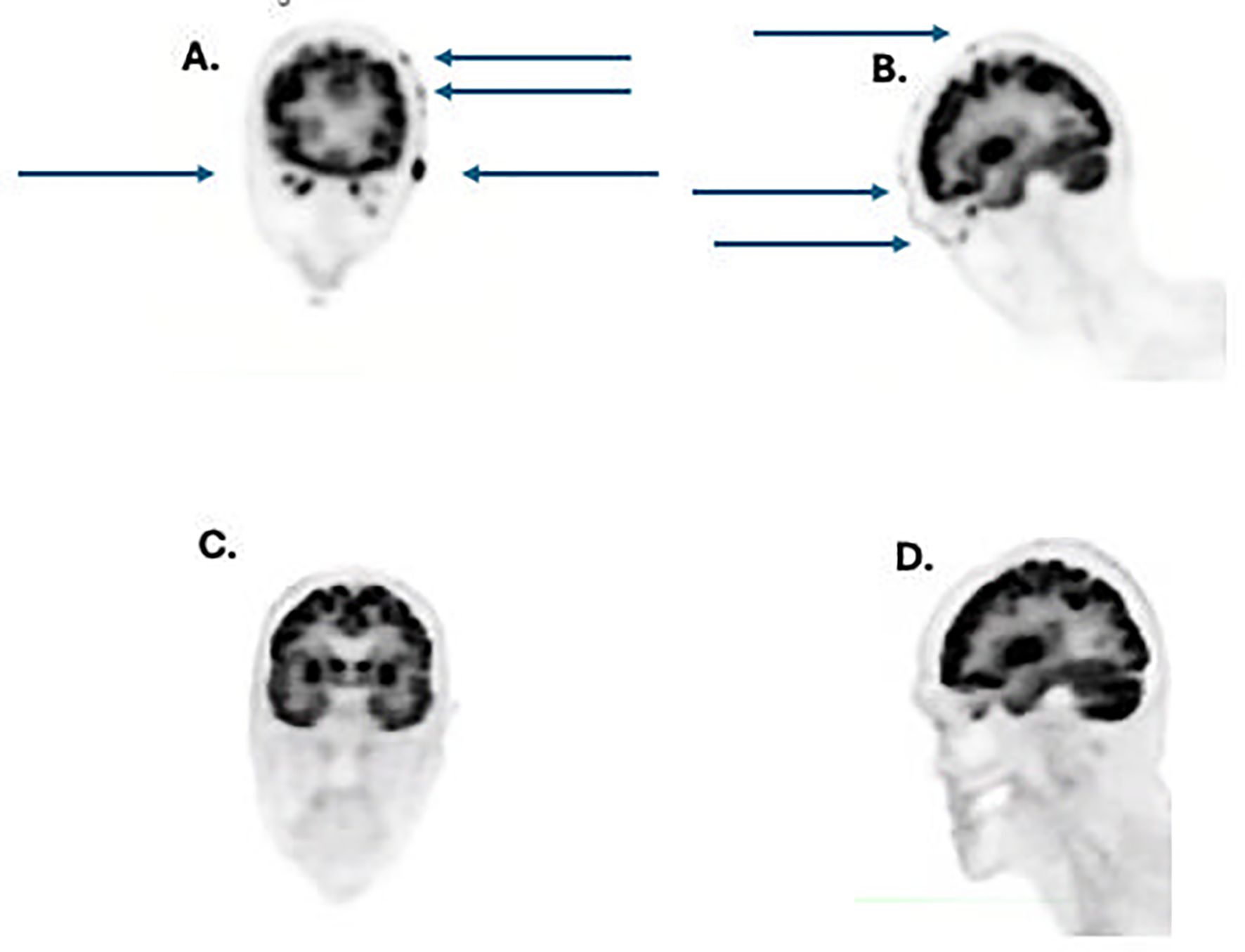 Four brain scans labeled A, B, C, and D. A and C display front views of brain activity, with black and gray areas indicating varying activity levels. B and D show side views. Blue arrows point to specific areas in A and B.