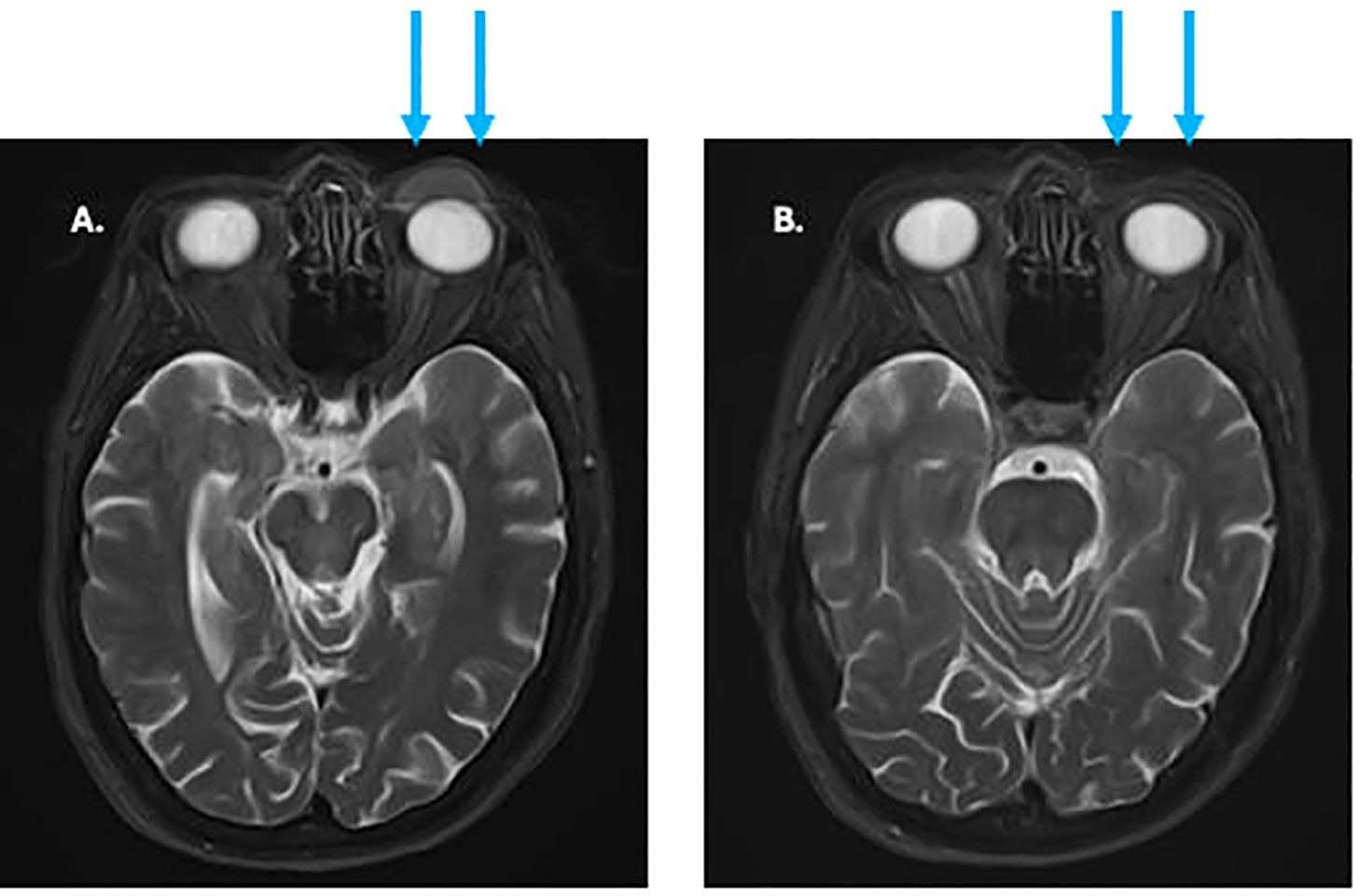 Two labeled MRI brain scans, A and B, show cross-sectional views. Both images depict the brain and eye sockets, with blue arrows pointing to the eye region, indicating areas of interest.