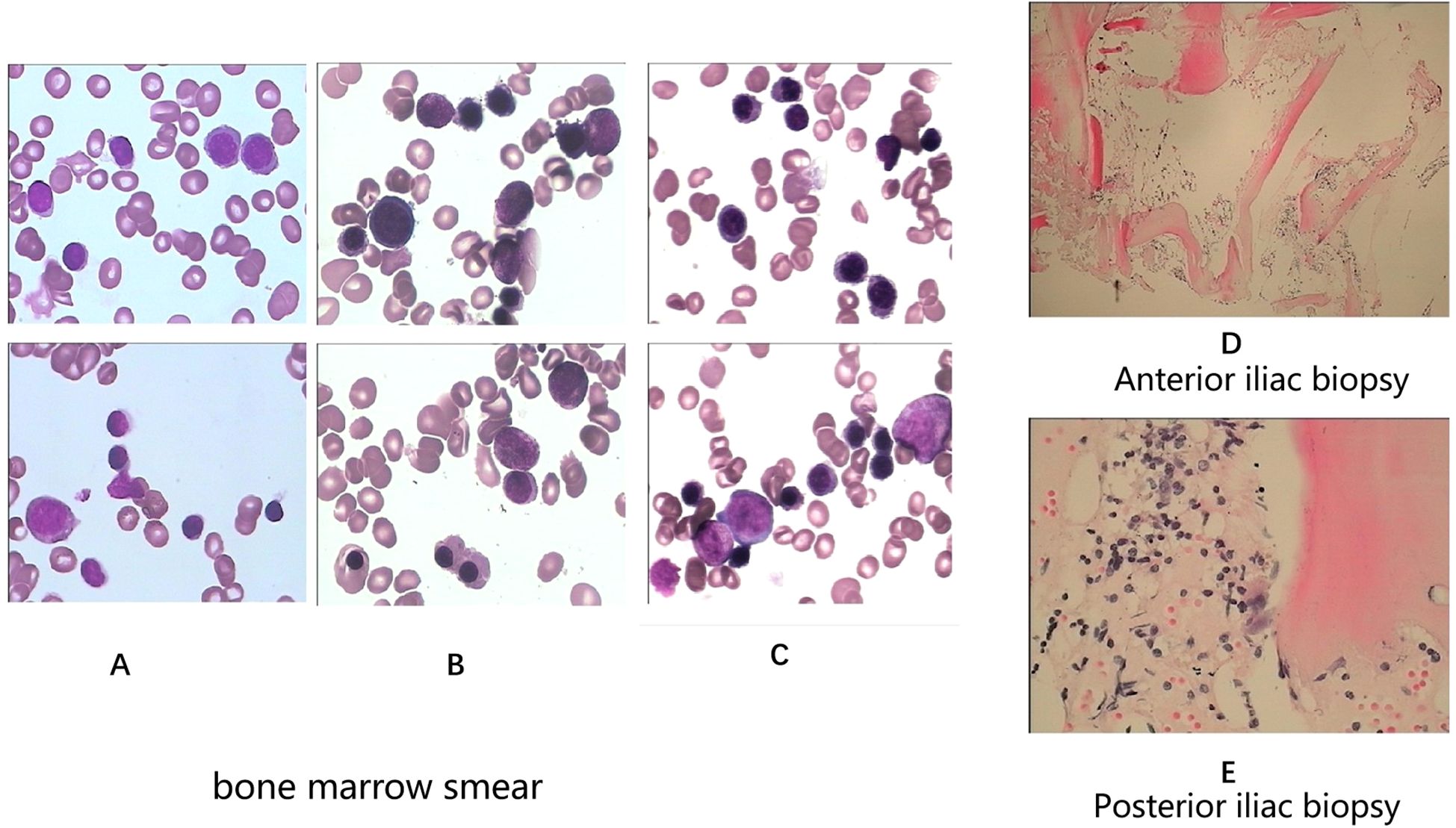 Bone marrow smears labeled A, B, and C show varied cellular compositions with purple-stained cells. Anterior (D) and posterior (E) iliac biopsies display tissue sections with bone and cellular details in different hues.
