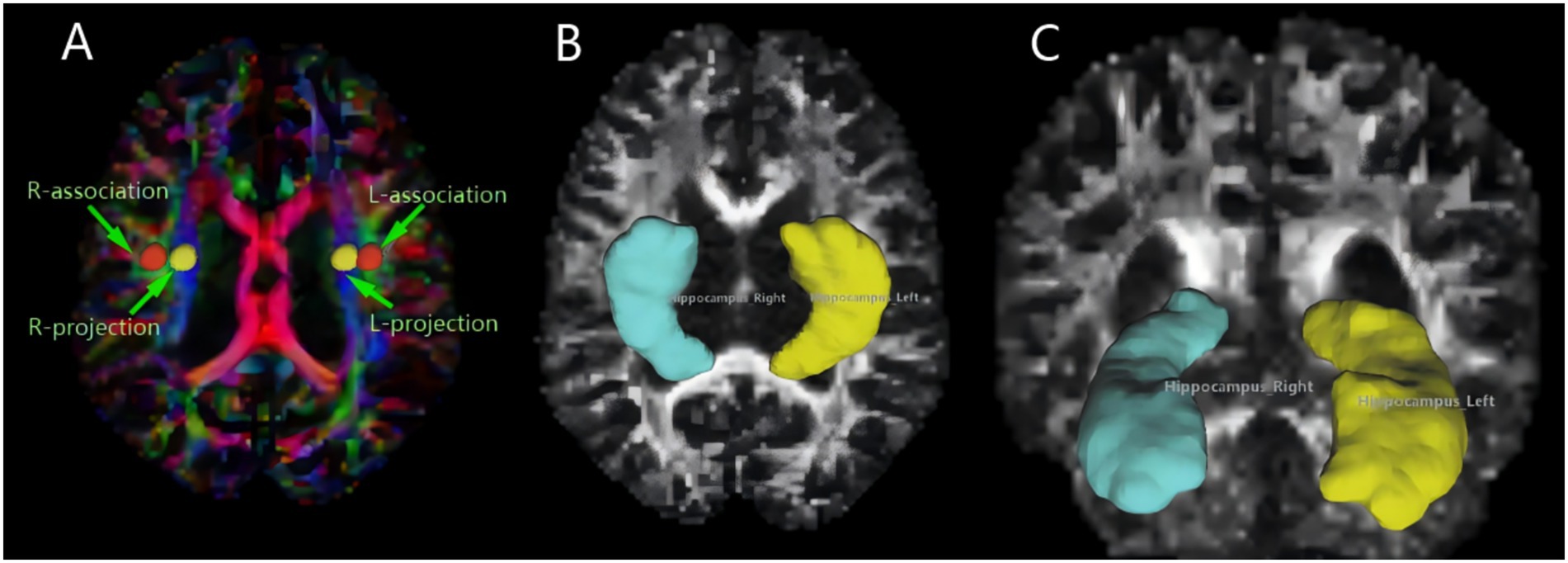 A composite image showing three brain scans labeled A, B, and C. Panel A highlights right and left associations and projections with multicolored tracts in the brain. Panel B and C display segmented hippocampi in blue and yellow within black-and-white scans.