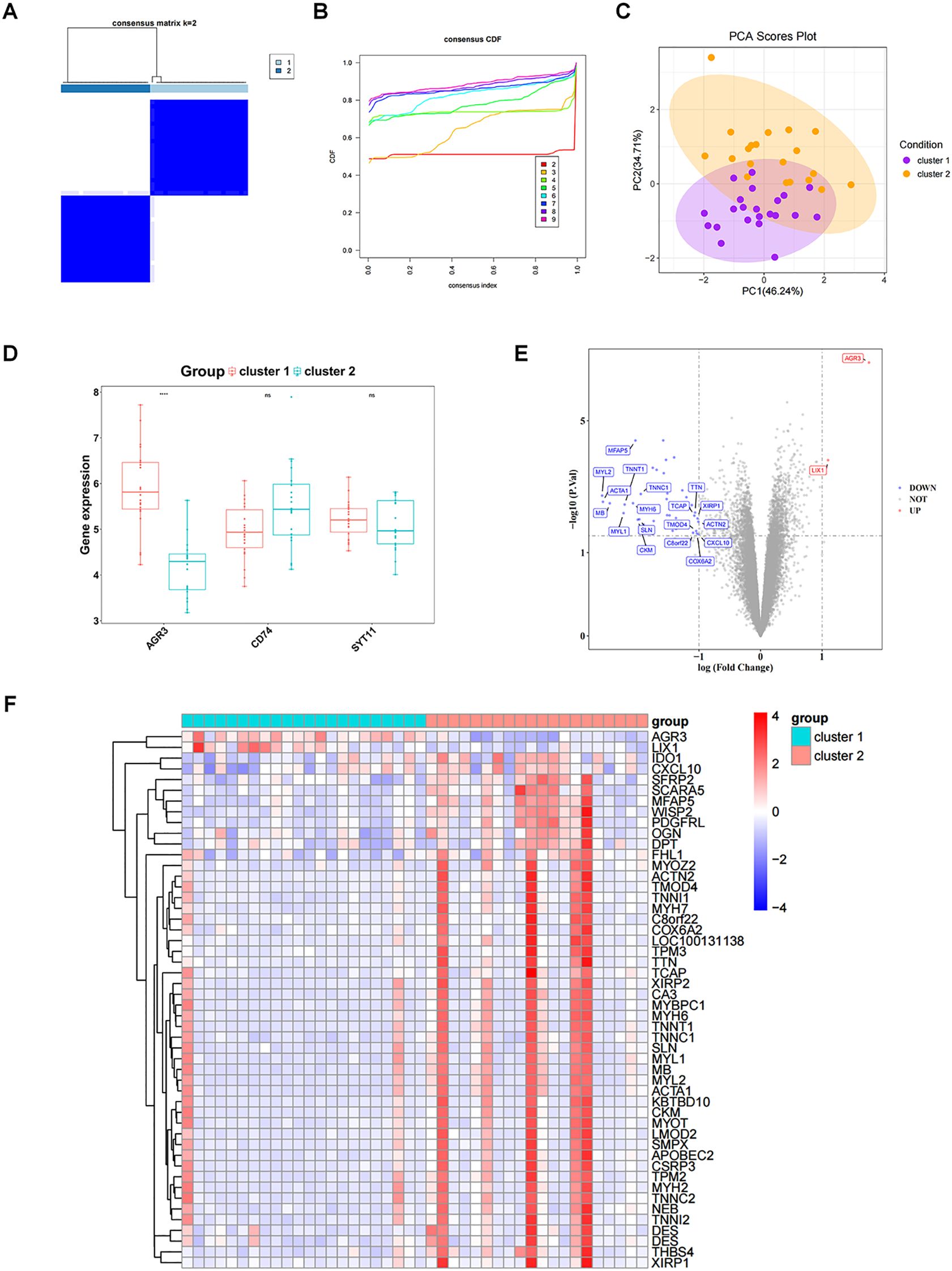 A composite image displaying multiple charts related to genetic data analysis. A: Consensus matrix heatmap for k=2 clusters, showing a clear division between two groups. B: Consensus cumulative distribution function (CDF) plot illustrating consensus index trends for k=2 to k=6. C: PCA scores plot with highlighted ellipses for cluster 1 and cluster 2, differentiated by color. D: Box plots comparing gene expression levels of AGR3, CD74, and STY11 between two clusters. E: Volcano plot showing the significance and fold change of various genes, highlighting specific genes like AGR3. F: Heatmap displaying gene expression profiles across clusters with a color gradient indicating expression levels.