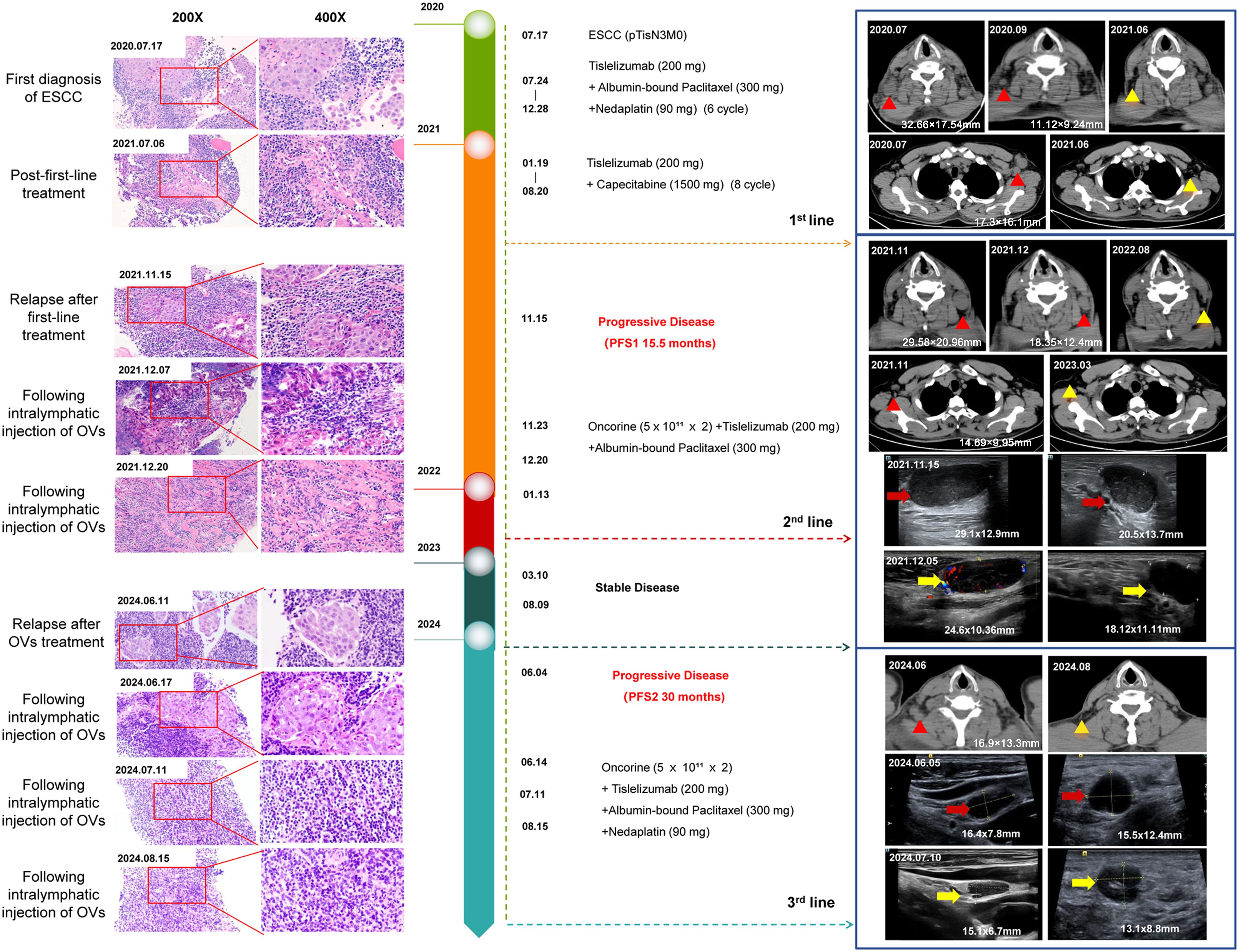 Diagram showing the treatment timeline and effects on esophageal squamous cell carcinoma (ESCC). Left side displays biopsy images at 200X and 400X magnifications, with treatment stages from first diagnosis in 2020 to 2024. Right side features CT and ultrasound scans with arrows indicating tumor sizes. A vertical timeline marks key dates and treatment lines, including the intralymphatic injection of oncolytic viruses (OVs) and resulting stable or progressive disease. Treatment regimens include Tislelizumab, Albumin-bound Paclitaxel, Nedaplatin, and Oncorine.
