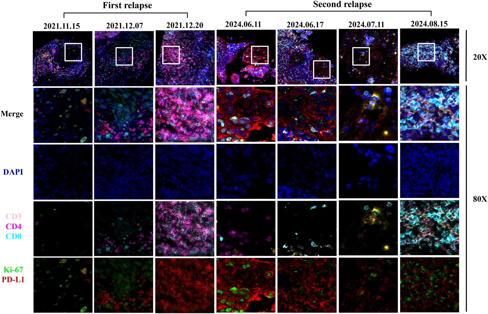 Fluorescent microscopy images showing immune markers during two cancer relapses, dated from 2021 to 2024. Rows display different staining: DAPI (blue), CD markers (CD3, CD4, CD8 in various colors), Ki-67 and PD-L1 (green and red, respectively). Images are captured at 20X and 80X magnifications.