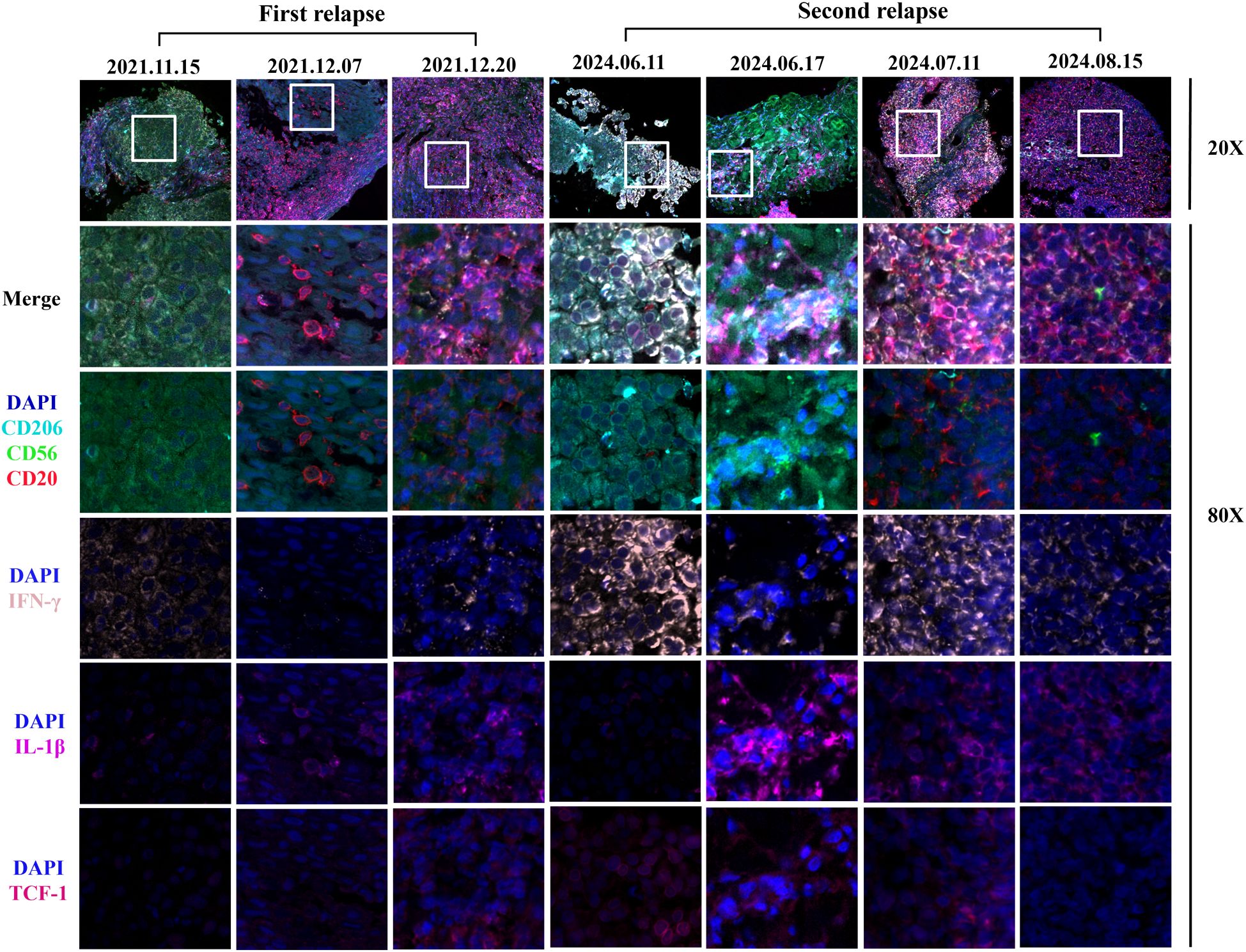 Microscopic images display tissue samples from two relapse events dated from 2021 to 2024. Each column represents a different date. The first row shows low magnification (20X), while the subsequent rows display higher magnification (80X) for specific markers: DAPI, CD206, CD56, CD20, IFN-γ, IL-1β, and TCF-1. Merged images highlight the expression levels and distribution of these markers, differentiated by colors for comparative analysis across dates.