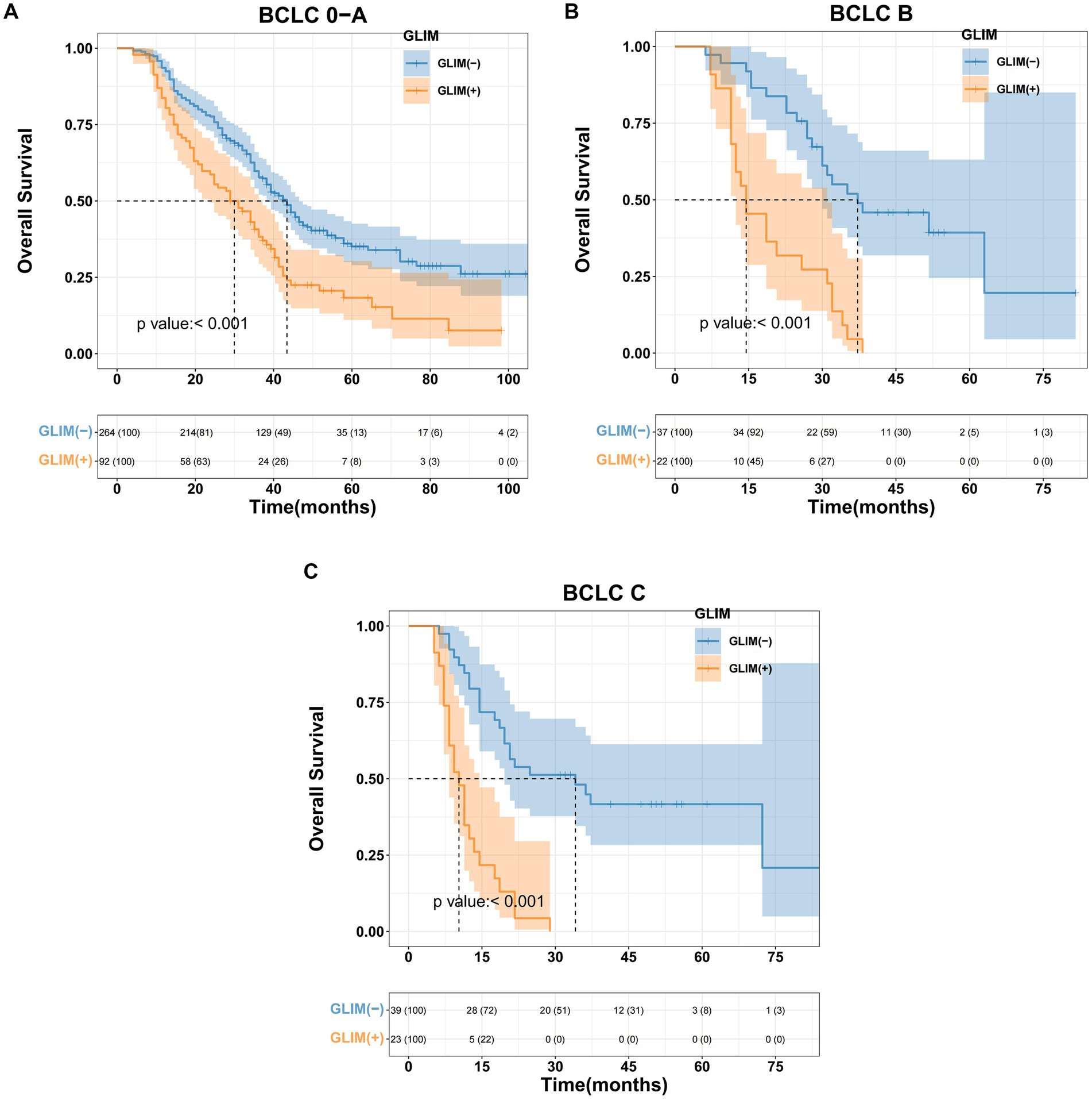 Kaplan-Meier survival curves for BCLC stages 0–A, B, and C, showing overall survival over time in months. Blue represents GLIM-negative patients, and orange represents GLIM-positive patients. All graphs indicate a significant p-value of less than 0.001, demonstrating differences in survival between the groups. The curves illustrate a decline in survival over time, with GLIM-positive patients showing lower survival rates across all stages.