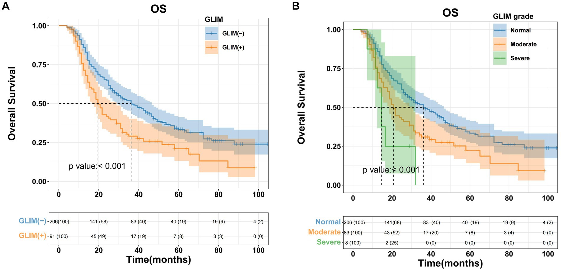 Two Kaplan-Meier survival curves compare overall survival time. Graph A contrasts GLIM positive and negative groups, with blue and orange lines showing survival differences. Graph B stratifies by GLIM grade: normal, moderate, and severe, using blue, orange, and green lines. Both graphs show a significant p-value less than 0.001. Tables below indicate sample sizes over time.