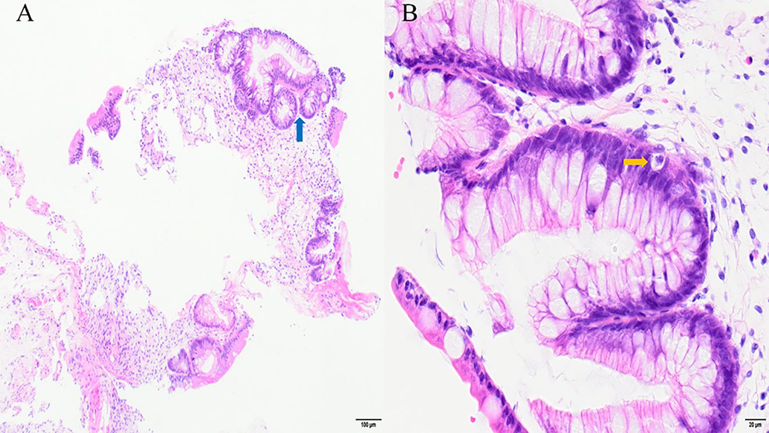 Microscopic images labeled A and B show tissue samples stained purple and pink. Image A illustrates a broader view with a blue arrow pointing to a specific area, while image B provides a close-up with a yellow arrow highlighting cellular details. Scale bars indicate magnification levels.