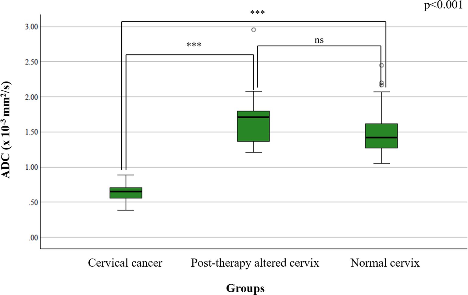 Box plot comparing ADC values across three groups: cervical cancer, post-therapy altered cervix, and normal cervix. Significant differences are marked by asterisks, with cervical cancer showing the lowest ADC. The p-value is less than 0.001.