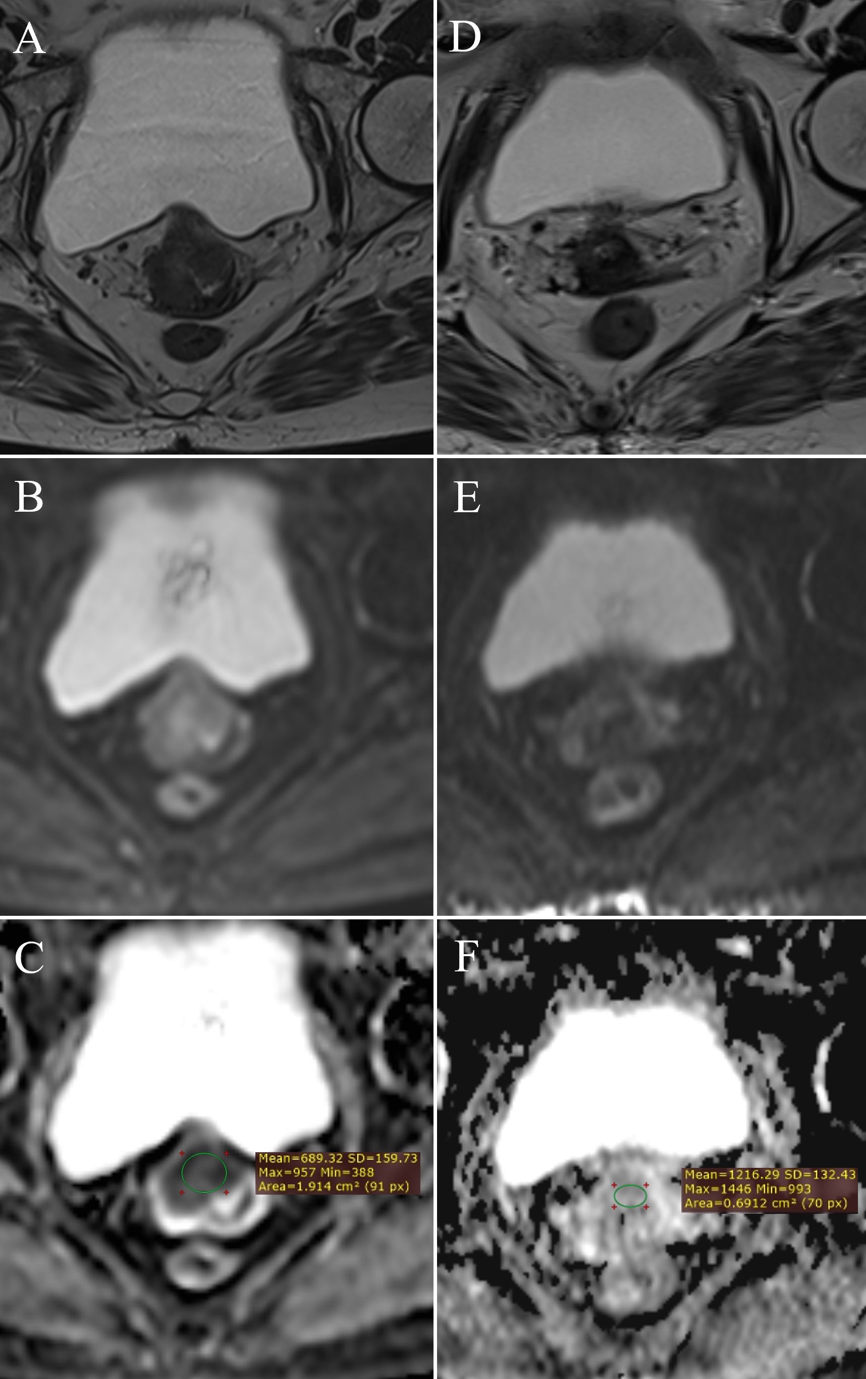 Six-panel image showing MRI scans labeled A to F. Panels A and D are T2-weighted scans revealing anatomical structures. Panels B and E are diffusion-weighted images highlighting tissue differences. Panels C and F display apparent diffusion coefficient (ADC) maps, with measurements indicating the region of interest, mean, standard deviation, max, min values, and area in square centimeters. Each panel illustrates variations in tissue contrast and measurement annotations.