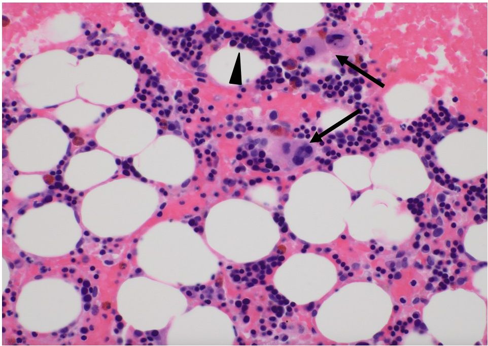 Microscopic image of bone marrow tissue showing large, circular adipocytes in white, surrounded by pink-stained connective tissue. Dark purple hematopoietic cells are scattered throughout. Black arrows indicate cellular details, and a black arrowhead points to a specific feature within the tissue.