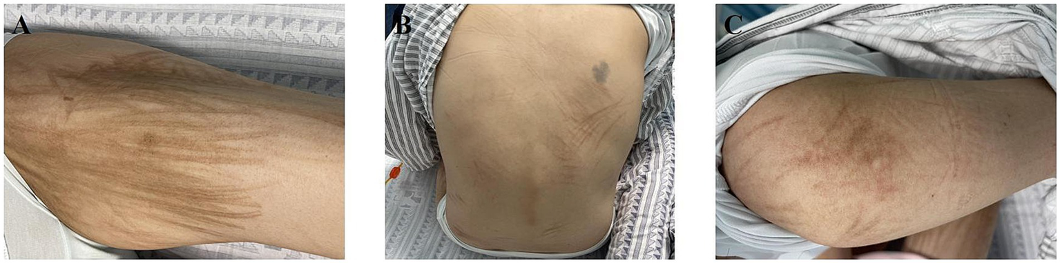 Three images labeled A, B, and C show close-ups of different thighs with visible striae or stretch marks. Each image displays varying degrees of striations on the skin.