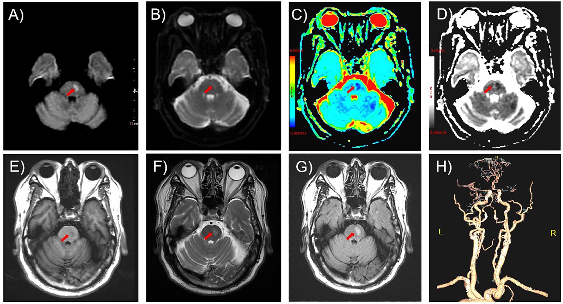 MRI and imaging scans of the brain are displayed in a grid. Images A to G show different brain views and sequences, including diffusion-weighted imaging and apparent diffusion coefficient maps, with red arrows highlighting specific areas of interest. Image H shows a three-dimensional reconstruction of cerebral arteries, labeled left (L) and right (R), highlighting their structure and flow patterns.