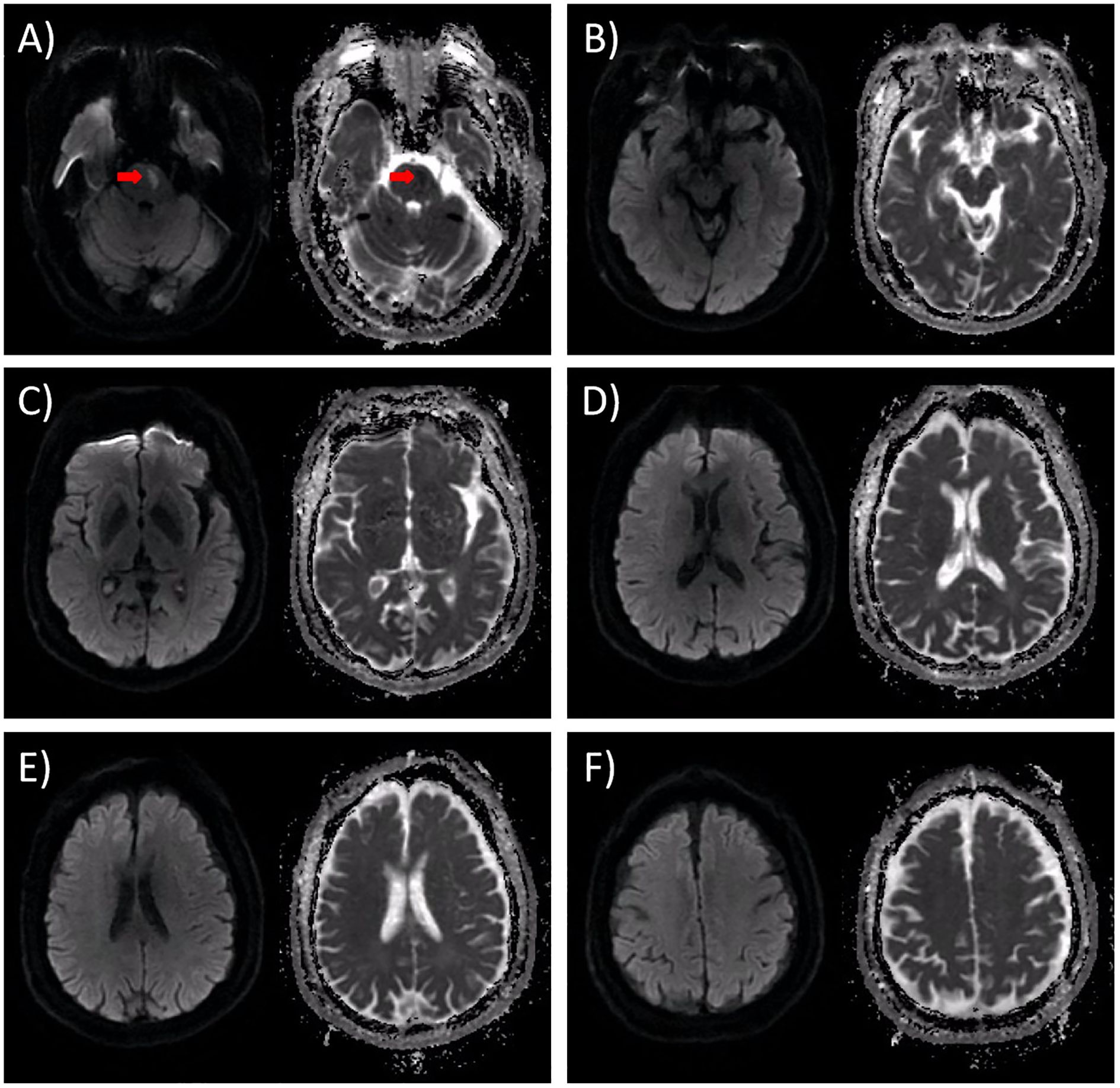 Six paired brain MRI images labeled A to F. Each pair contains a diffusion-weighted image on the left and an apparent diffusion coefficient map on the right. Image A features a red arrow indicating a specific area on both images. The remaining images show various cross-sections of the brain without additional markings.