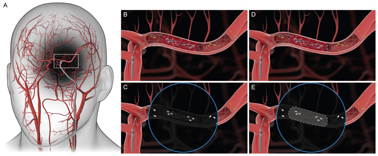 Diagram of a human head showing blood vessels with a highlighted area in the brain (Panel A). Close-up views of a cerebral artery are shown in Panels B through E. Panel B depicts a blockage, while Panels C and E illustrate stent placement and blood flow restoration. Panel D shows the post-procedural blood flow.