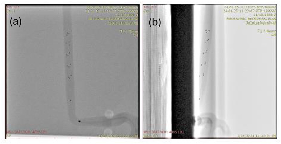 X-ray images labeled (a) and (b) display a medical device or tubing with a series of small markers or dots inside. Image (a) shows a slightly curved tube, while image (b) displays a straighter section. Both images contain technical annotations and measurements.