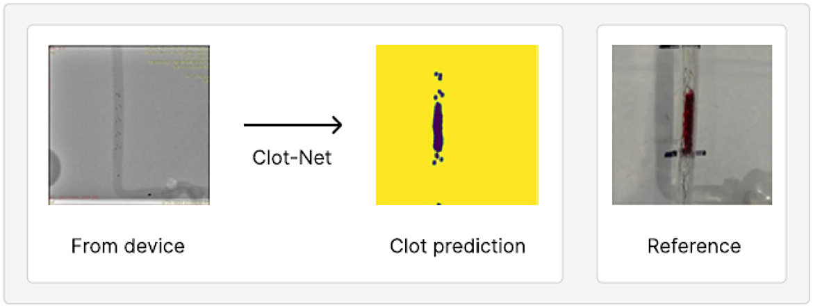 Three-panel image showing a process of clot detection. The first panel is labeled “From device” and shows a gray-scale image. The second panel, labeled “Clot prediction,” features a bright yellow background with a dark purple shape representing a clot. The third panel, labeled “Reference,” displays a clear image of a clot within a device.