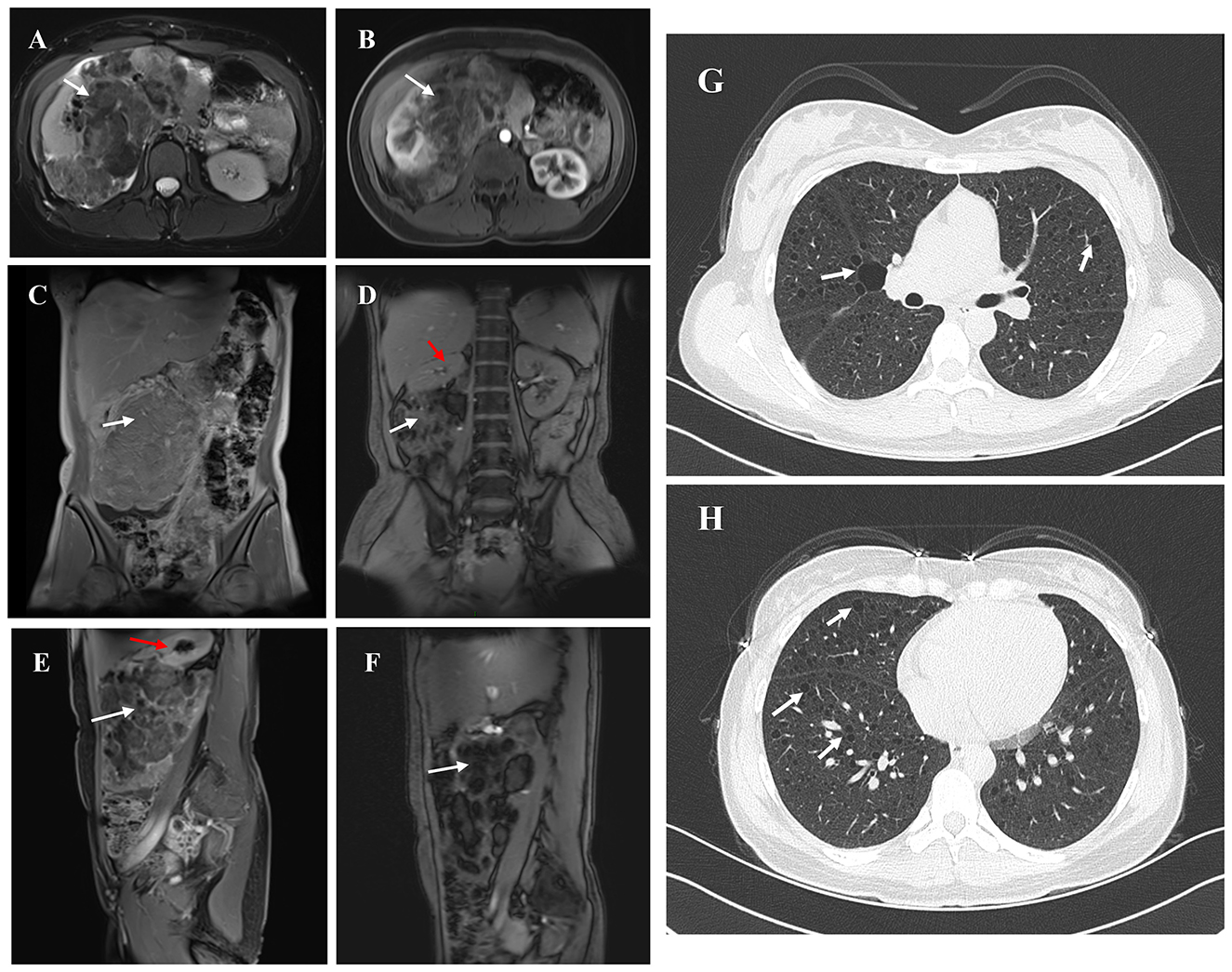 MRI and CT scans in panels A to H show various views of abdominal and chest areas. Arrows highlight abnormalities, such as lesions or masses, in different sections of the liver, spine, and lungs. Panels A to F focus on abdominal regions with visible differences in tissue density, while panels G and H show cross-sectional lung images with notable markings indicating potential issues.